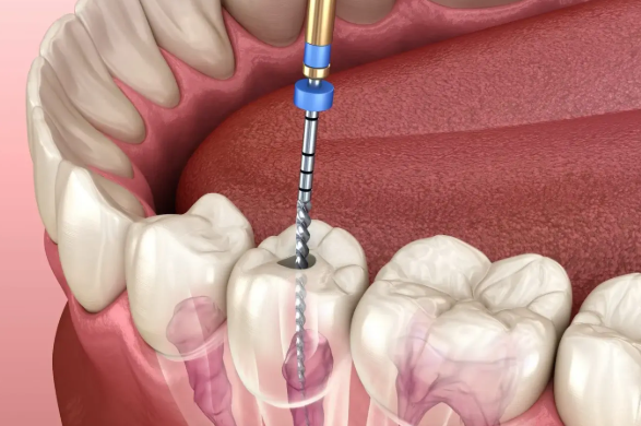 Root Canal Treatment